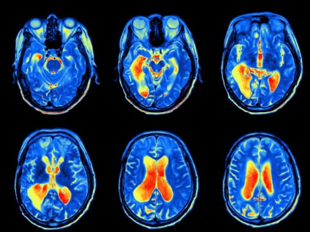 S.A.N.E. method: benefits detected by the eeg (electroencephalogram)